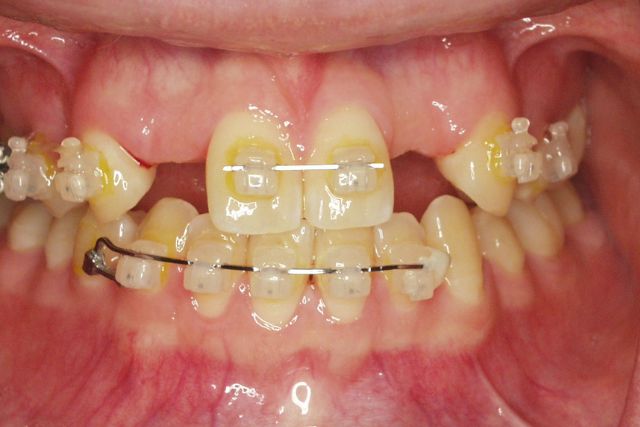 削らない接着ブリッジ：歯科治療の革命